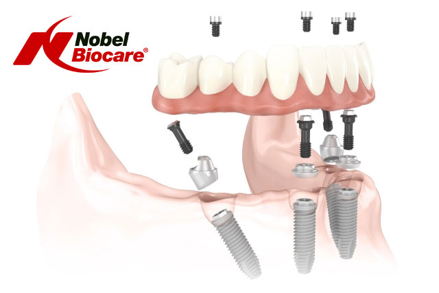 All-on-4® dental implants from Nobel Biocare®
