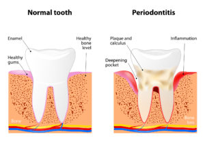 periodontitis drawing 
