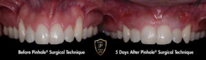 before and after results of pinhole surgical technique