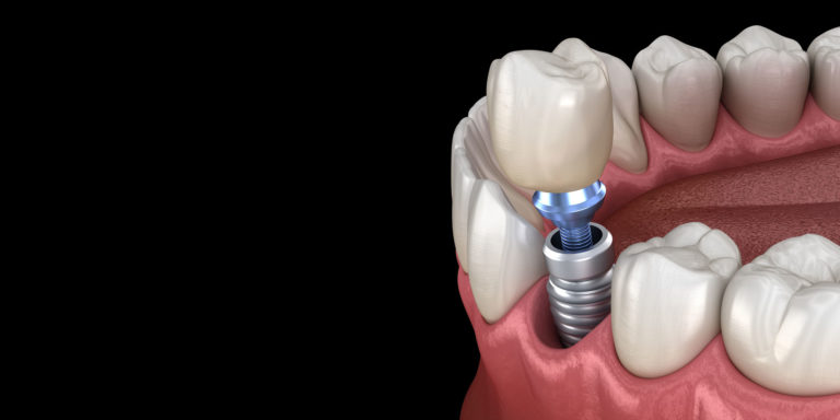 dental implant model