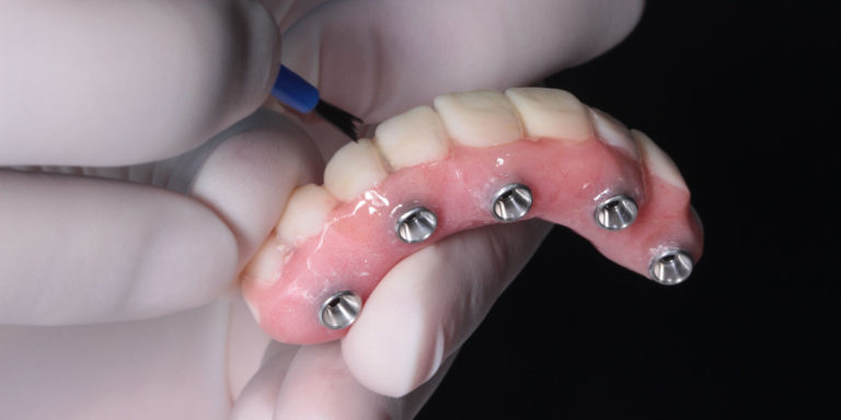 full arch dental implant model