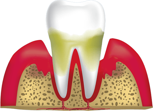 gum disease stage 4