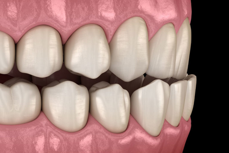 malocclusion model