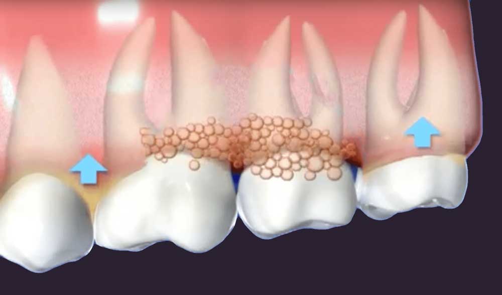 diagram depicting gums affected by gum disease