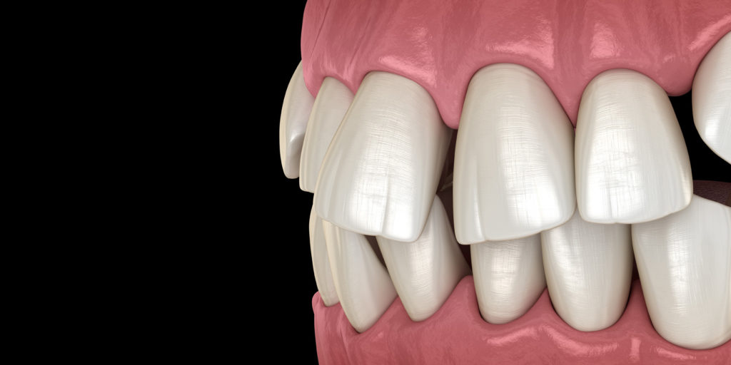 Occlusal (Bite) Adjustment in Monroe, CT Dr. Richard Amato