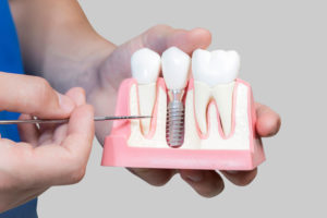 Dental Assistant Showing Off A Dental Implant In A Jawbone Cutaway Model in Monroe, CT