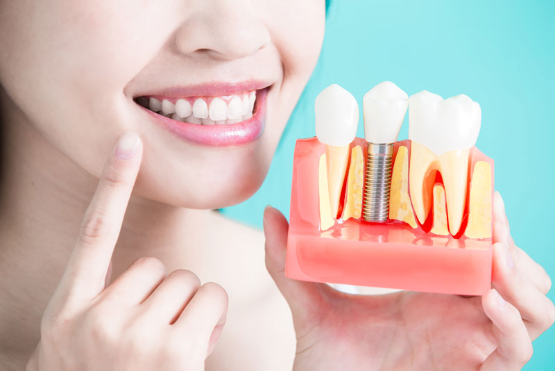 a patient smiling as she is holding up a dental implant model next to her face and pointing at her smile because a periodontist is going to place her dental implants.
