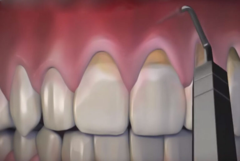 An image of teeth and gums for a pinhole surgical technique.