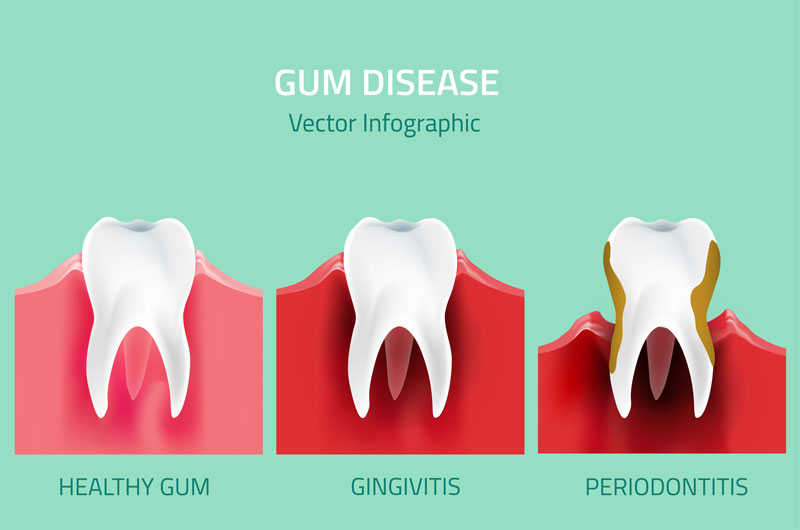 visual model of gum disease