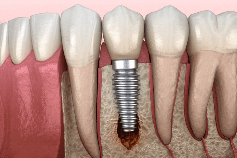 a failing dental implant digital model.