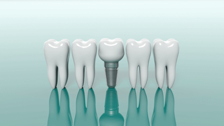 3d model of 4 teeth with a dental implant in the middle of them