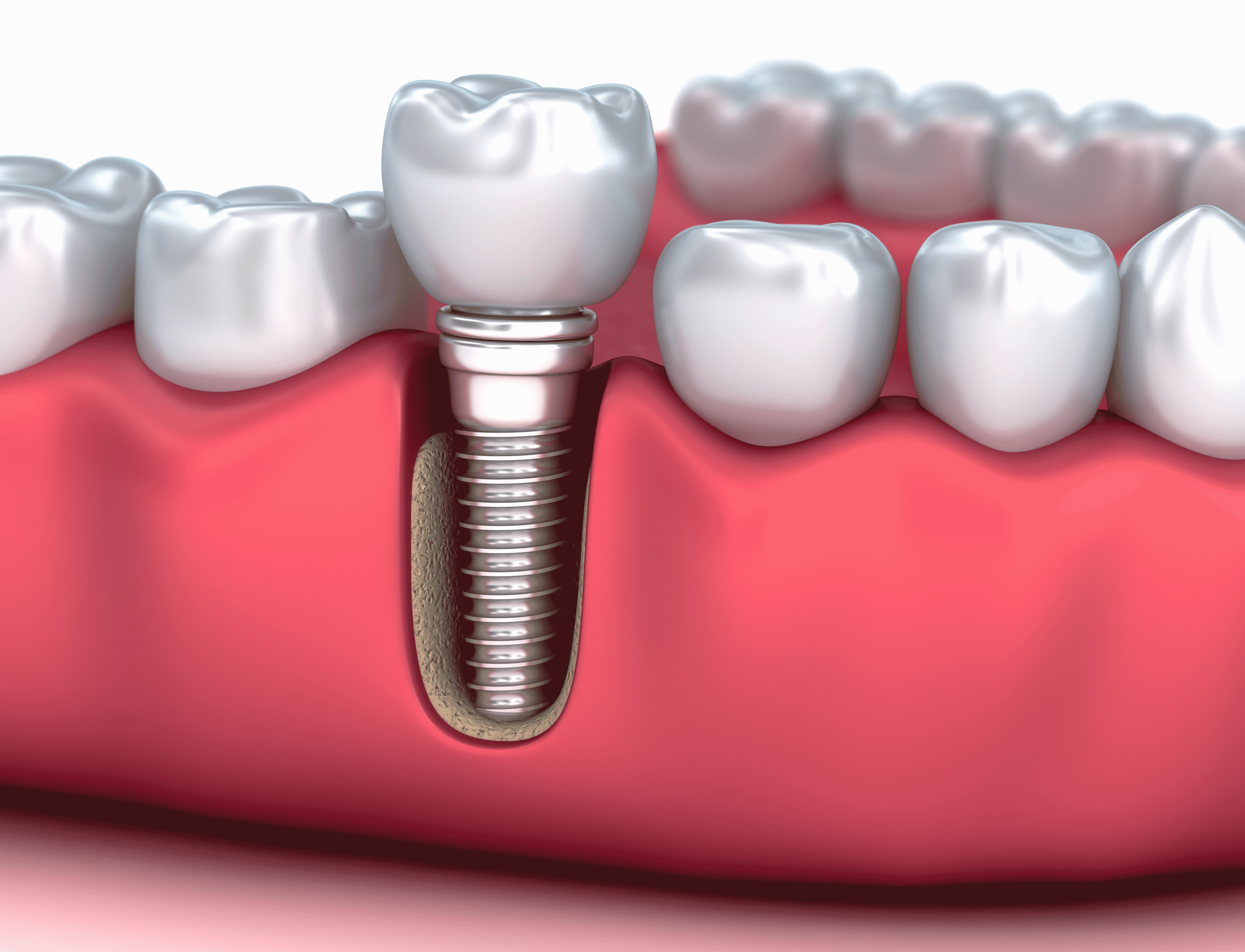 Medically accurate 3D illustration of a Dental Implant