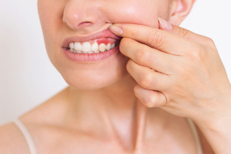 Image of a women lifting up her gums to show inflammation