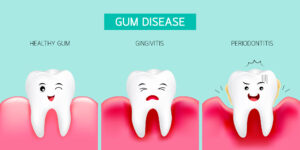 Three stages of gum disease: a healthy tooth, early gingivitis with mild redness and swelling, and advanced periodontitis with severe gum erosion.