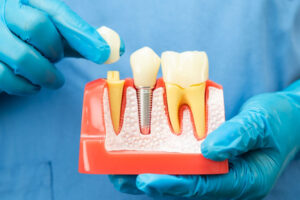 Dentist wearing blue gloves holding a dental implant model, demonstrating the components of a tooth implant including crown, abutment, and titanium post for patient education.